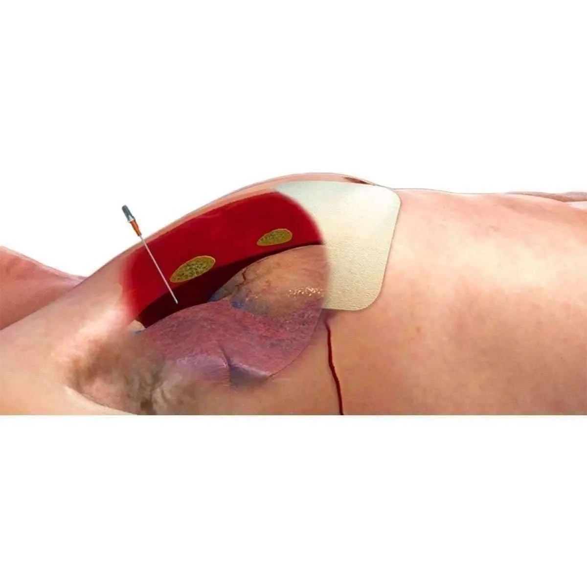 ARS for Needle Decompression